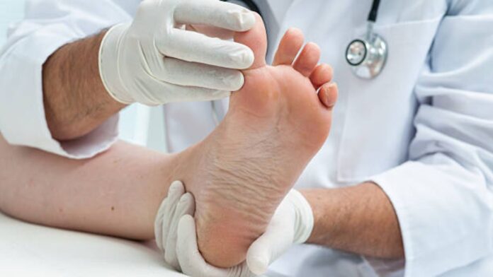 Athlete's Foot Fungal Infection Understanding the Impact of Wet Feet