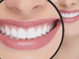 Britegums procedure