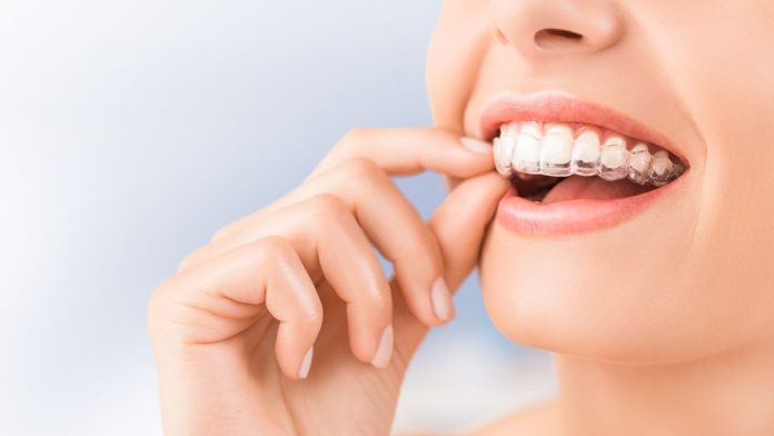 The Ultimate Guide to Invisalign